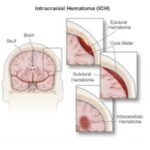 Hematomas Intracranianos e Acidente Vascular Encefálico Hemorrágico