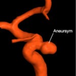aneurismas-intracranianos